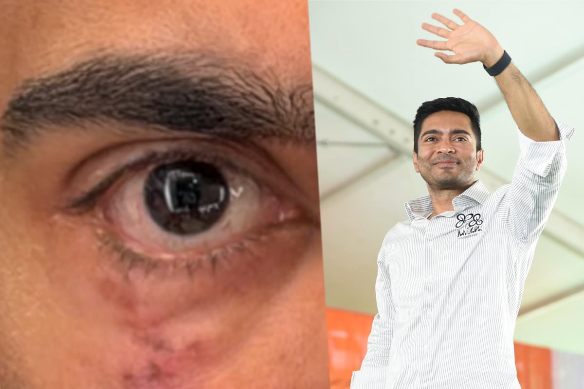 During deep crisis for the Trinamool, Abhishek Banerjee went to America for treatment, what exactly happened to his eye?